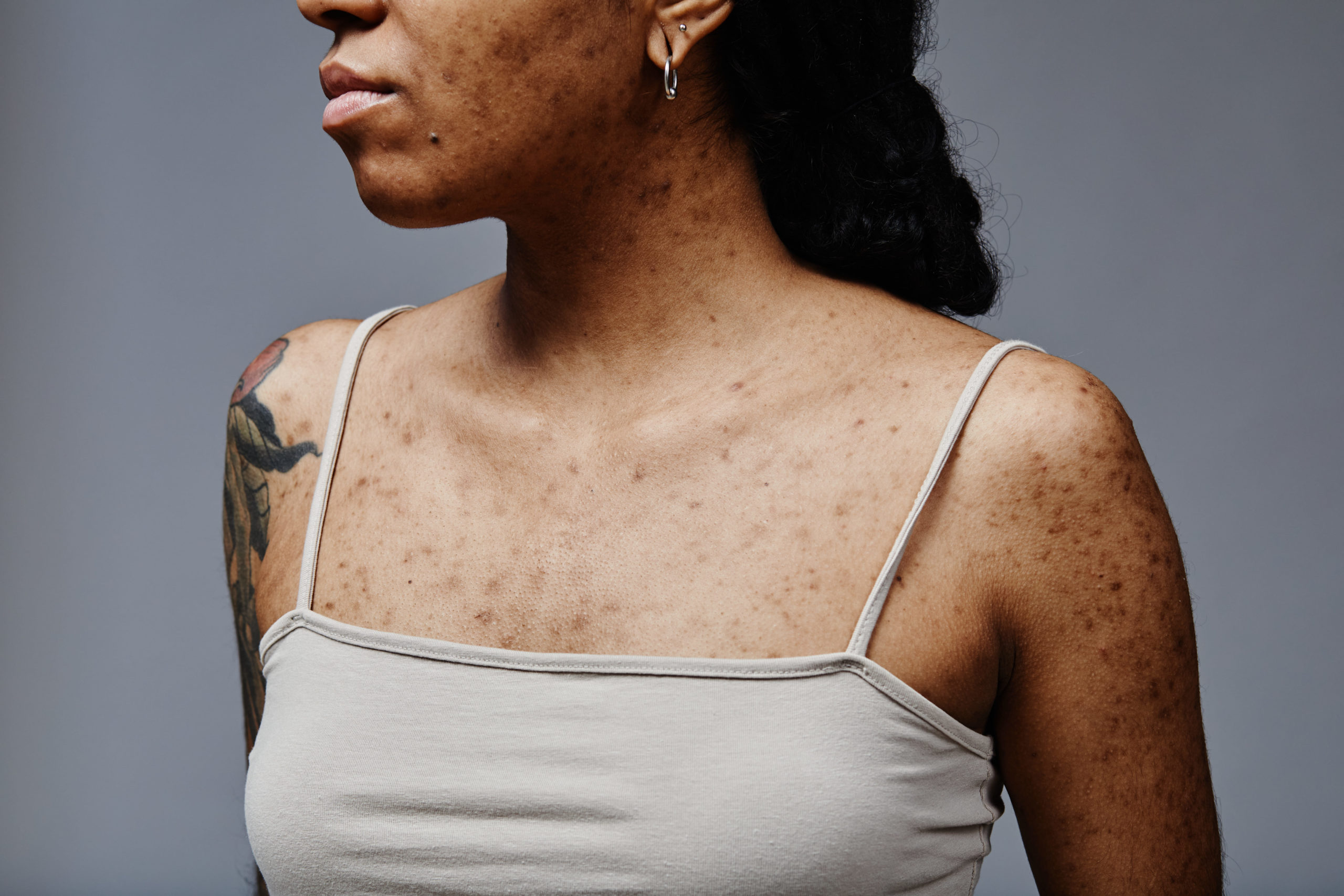 Pigmentation and textures