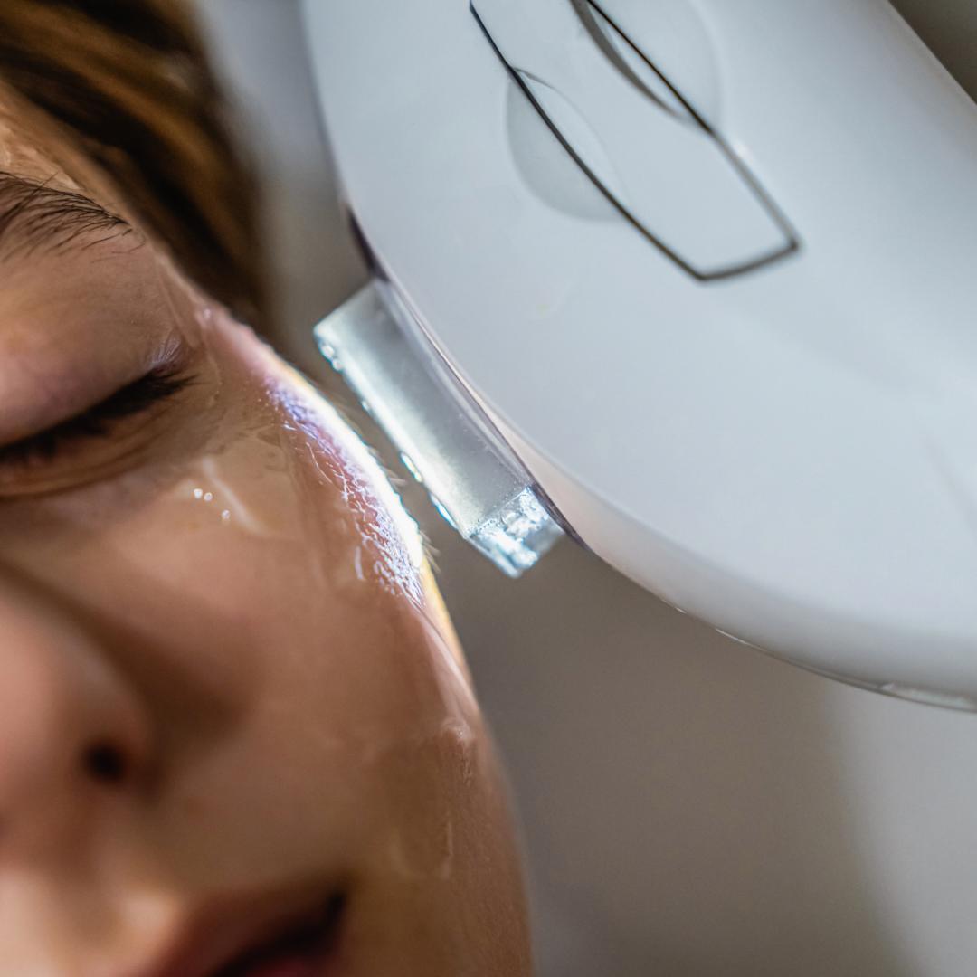 IPL Rejuventaion Therapy 2