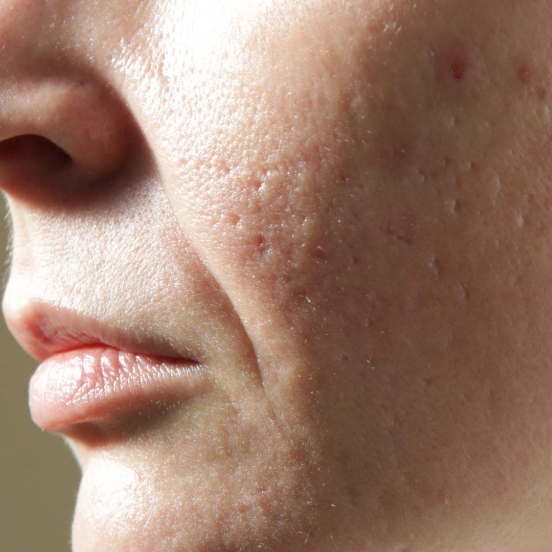 Acne Scars