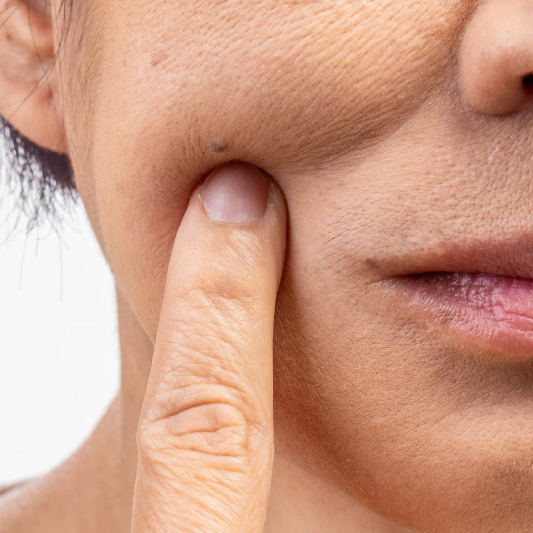 Aging Dry Dehydrated Skin