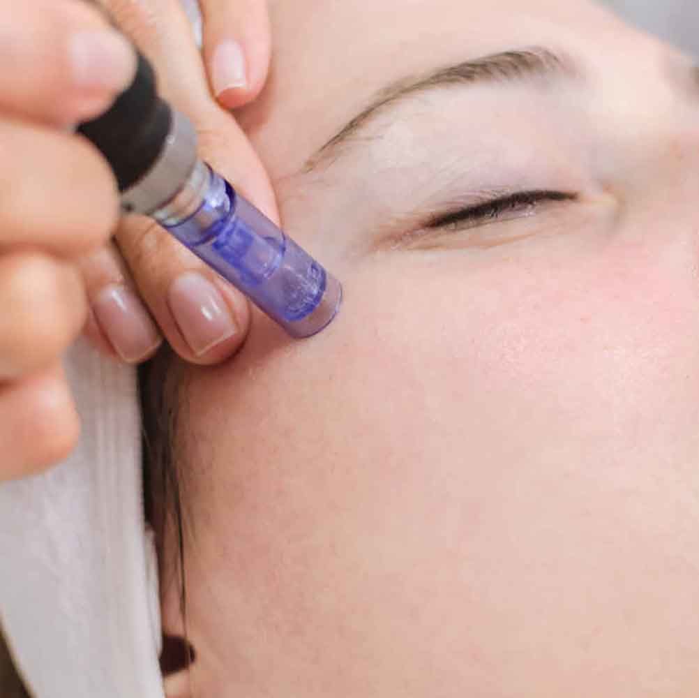 Microneedling 3