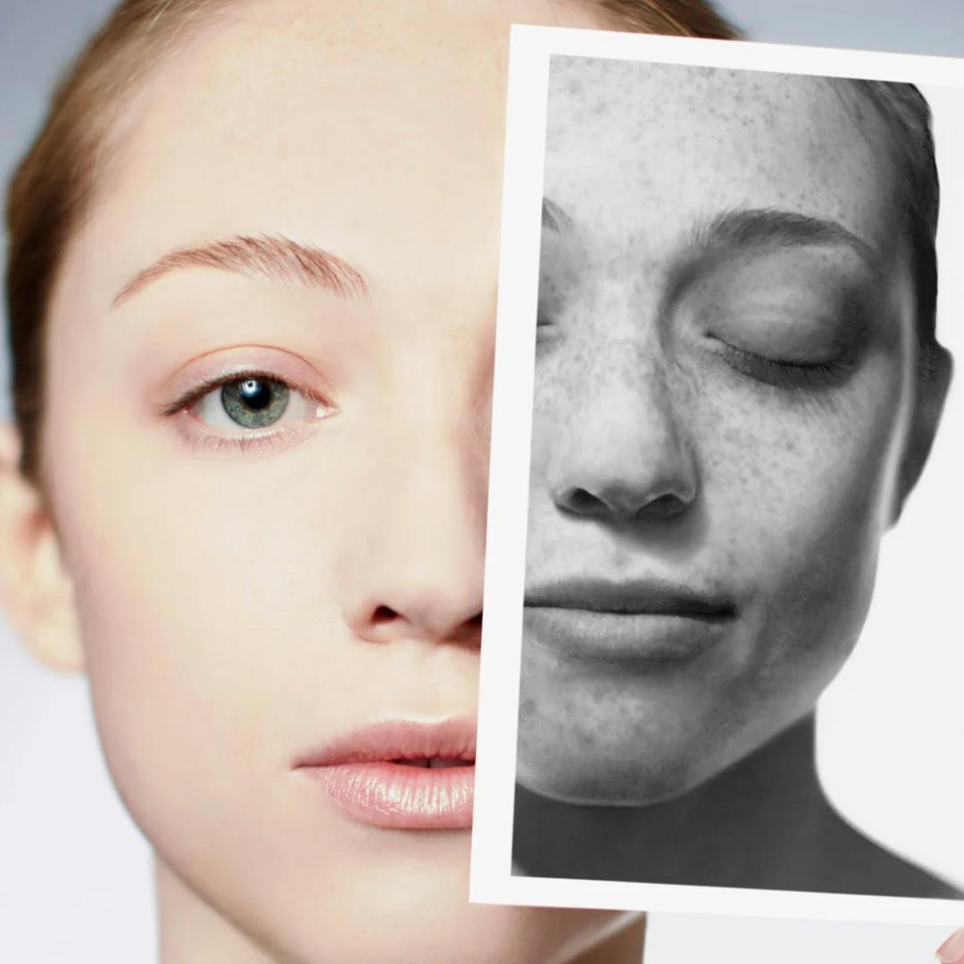 Pigmentation before after