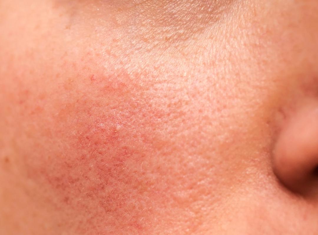 Redness from Rosacea 2