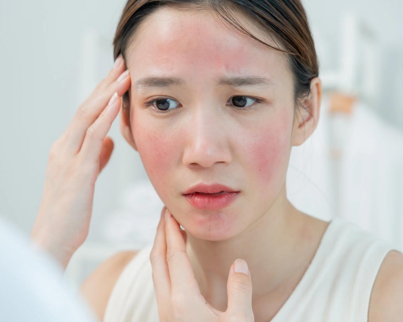 Redness from Sensitive Skin