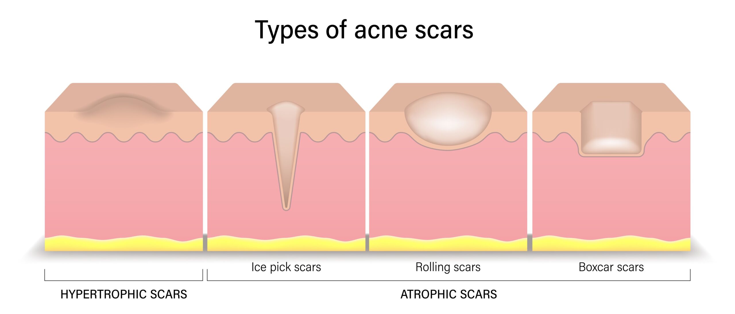 Scar types